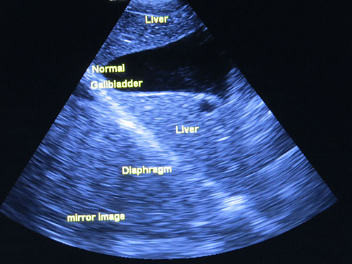 Healthy kidney (right kidney)