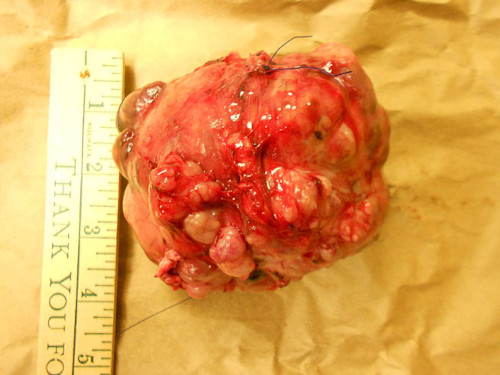 kidneymass1