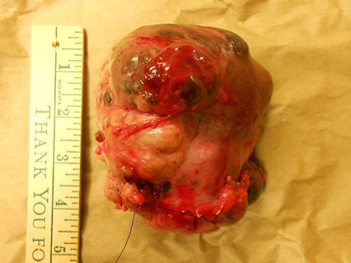 kidneymass2