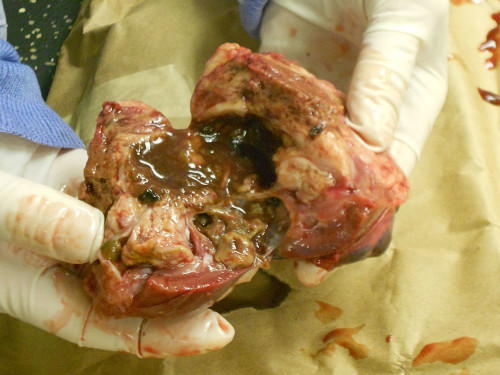 kidneymass3