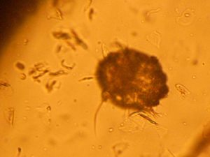 The photo above shows one of the Sarcoptes Scabiei we found under the microscope.