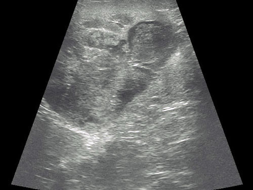 Left kidney with proliferative mass